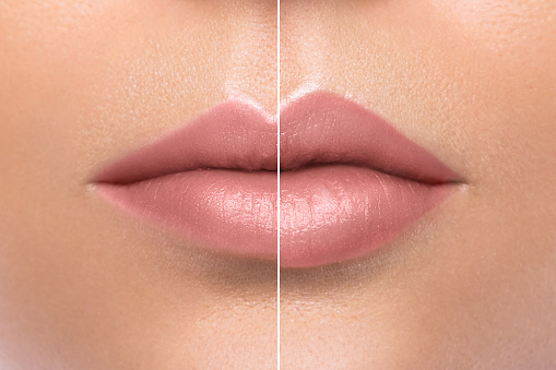 Comparison of female lips before and after augmentation