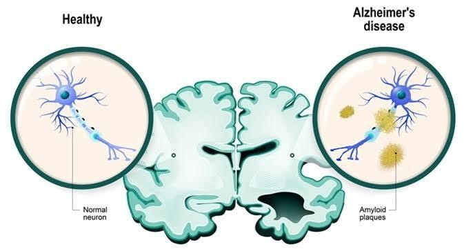 ALZHEIMER’S HEREDITARY 2