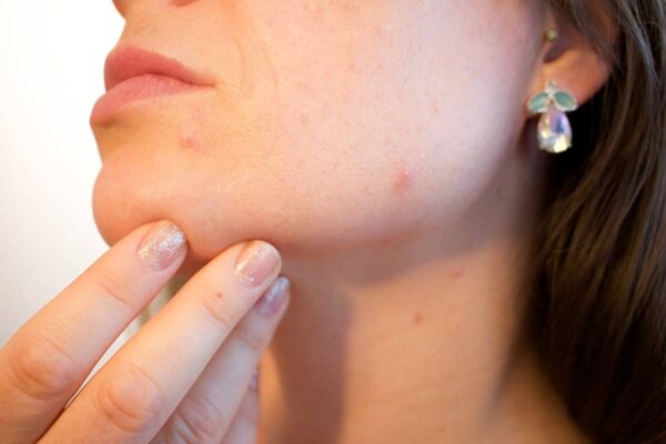 Most  Effective Home Remedies To Get Ride Pimples
