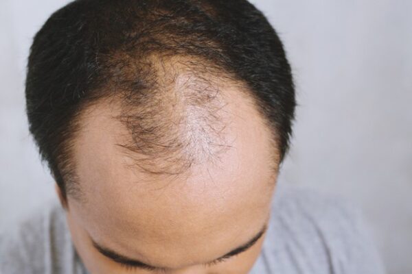 What Are The Main Causes Of Alopecia?