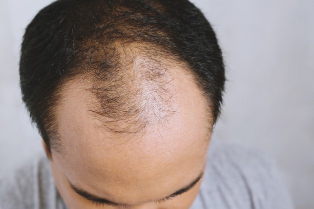 alopecia