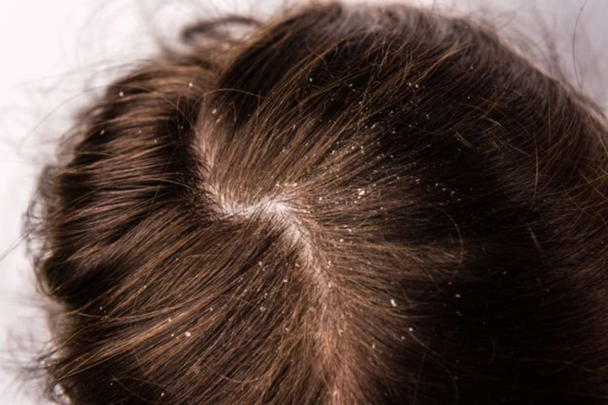 What Are The Causes Of Dandruff And How To Rid