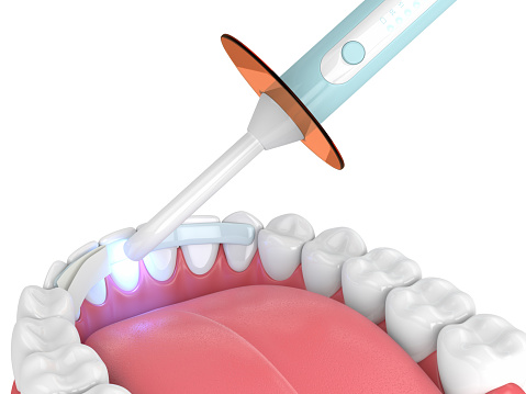 NOV: Dental Bonding