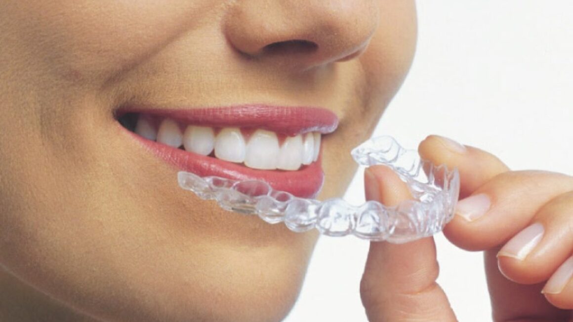 What Should I Expect The First Few Days of Invisalign