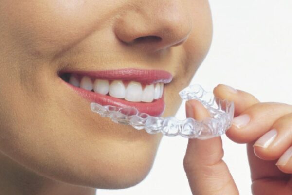 What Should I Expect The First Few Days of Invisalign?